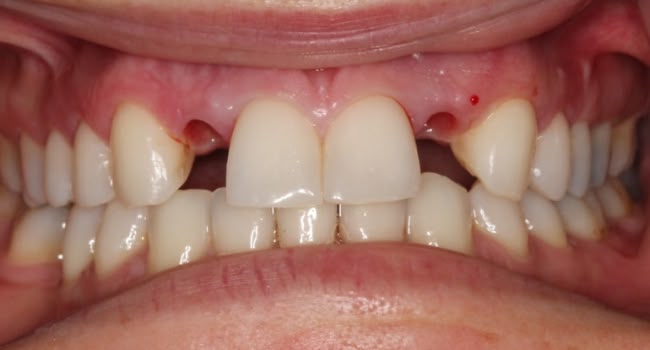 Missing front teeth with dental implants and gum tissue healing.