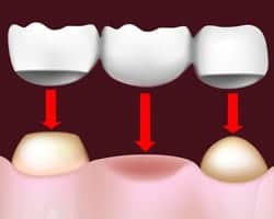 Healthy dental crowns supporting natural teeth in a dental restoration.
