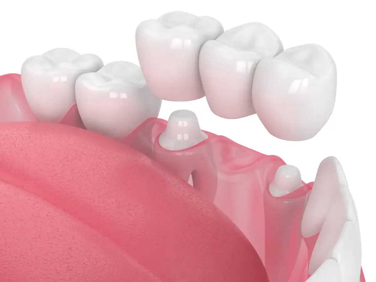 A dental implant with surrounding natural teeth and gums.