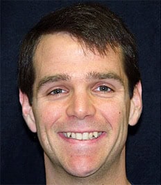 A smiling man with teeth needing correction