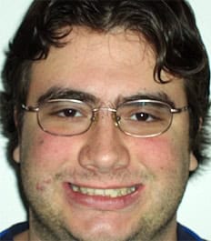 A smiling man with glasses with crowding issues and deep bite