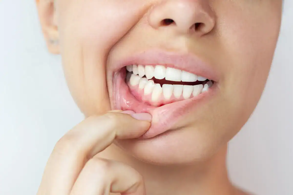 A smiling person showing healthy teeth and gums, close-up of dental health.
