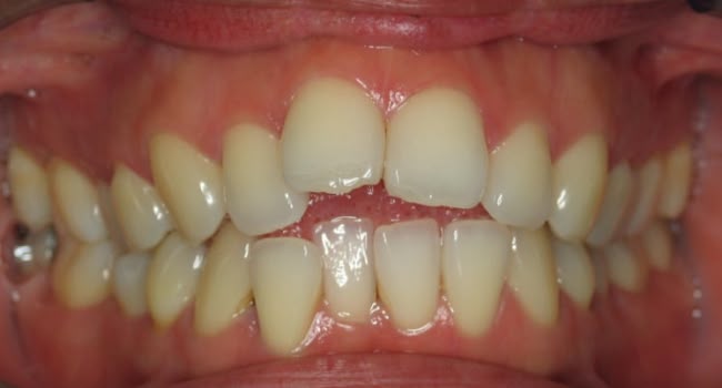 A smile with crooked teeth