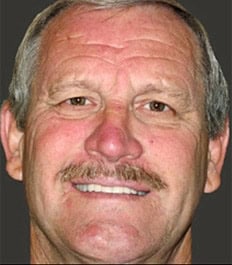 A smiling middle-aged man with a mustache without teeth spacing issues