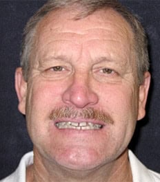 A smiling middle-aged man with a mustache with teeth spacing issues