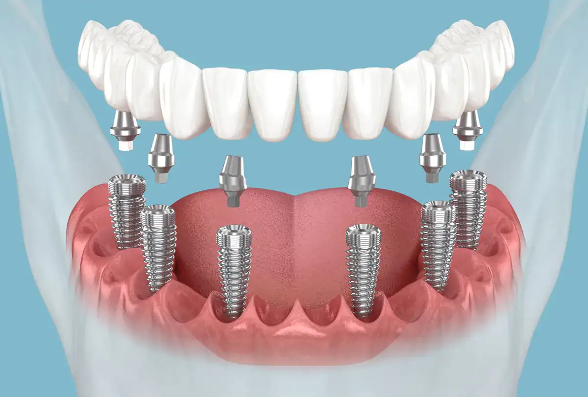 Dental implant-supported dentures with multiple implants in the lower jaw.