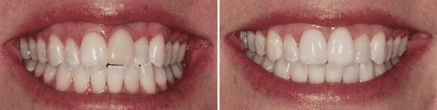 Bright, healthy smile with white teeth and even alignment at Rincon Dental.