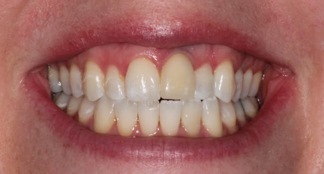 Close-up of a person's smile showing unhealthy healthy teeth