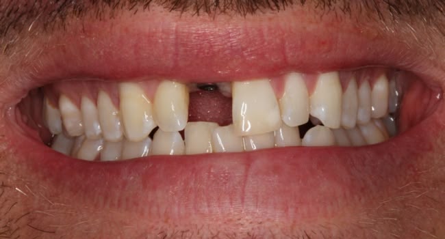 A smiling mouth showing missing and damaged teeth with dental issues.