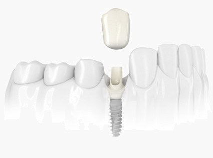 A dental implant with a crown and surrounding teeth at Rincon Dental.