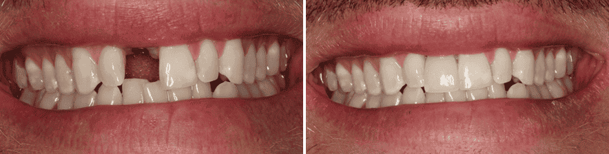 Bright smile with healthy, white teeth at Rincon Dental clinic.